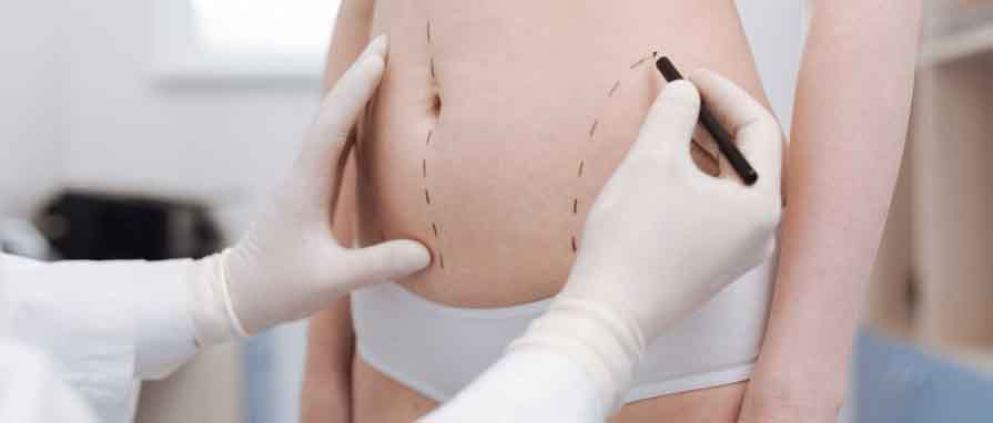 Liposuction: Say Goodbye to Unwanted Fat!