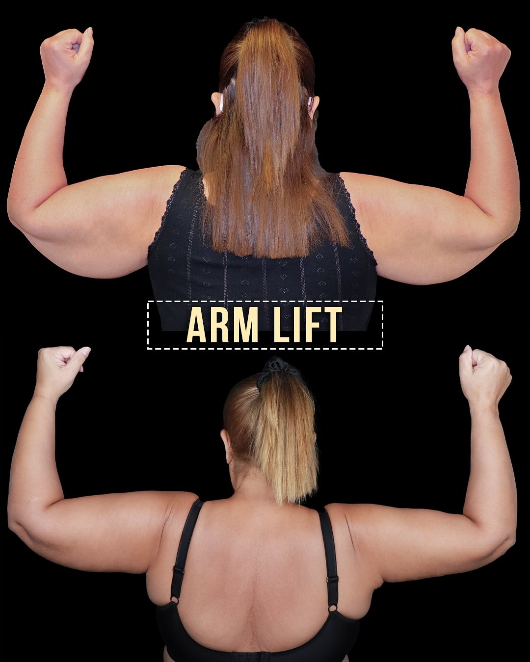 Why Do My Arms Stay Flabby Even After Weight Loss? – burakpasinlioglu.com